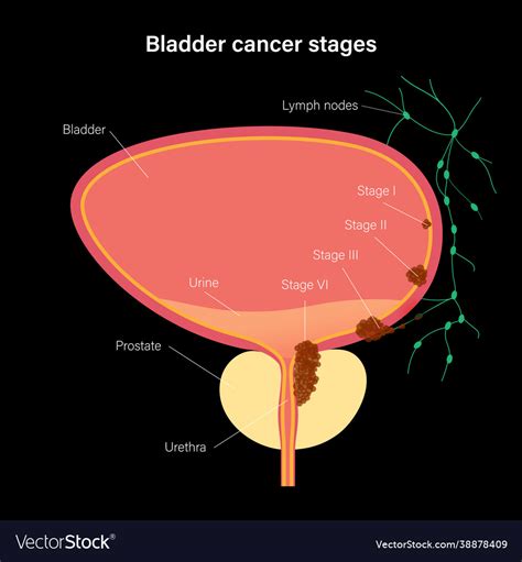 Bladder cancer stages Royalty Free Vector Image