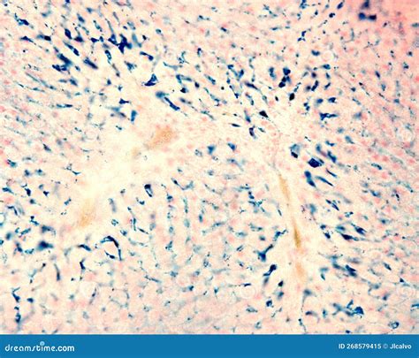 Liver. Kupffer Cells Loaded with Iron. Perl’s Reaction Stock Image - Image of hepatocyte ...