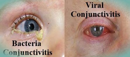 Difference between Bacterial and Viral Conjunctivitis | Conjunctivitis ...