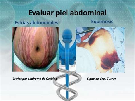 Semiologia de abdomen :)