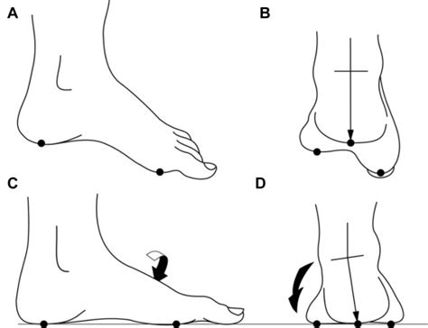 Anatomy and Biomechanics of Cavovarus Deformity - Foot and Ankle Clinics