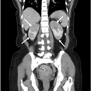 CT Scan of bilateral renal infarctions. CT scan of abdomen and pelvis ...