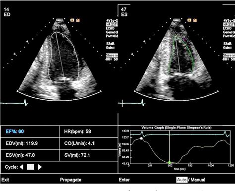 Clinical utility of automated assessment of left ventricular ejection fraction using artificial ...