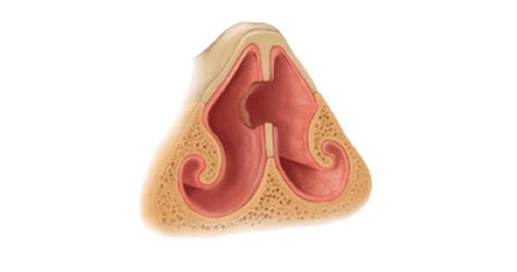 What is a Septal Perforation?