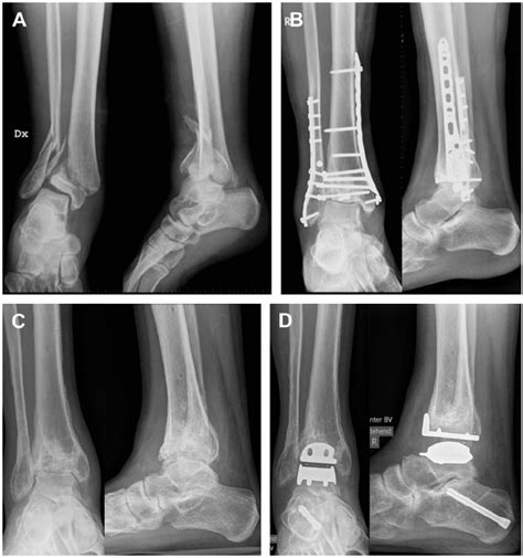 Ankle Arthritis Symptoms, Causes, and Treatments | OrthofootMD