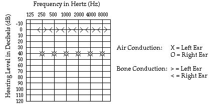 Conductive Hearing Loss | Causes, Symptoms & Best Treatment