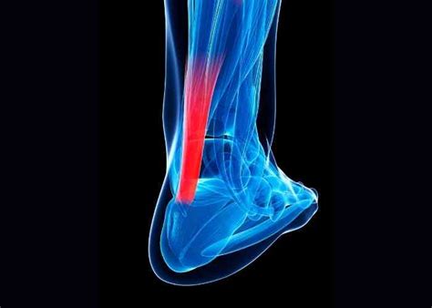 Achilles Tendon Injury | Ankle Specialist | Sugar Land, Pearland ...