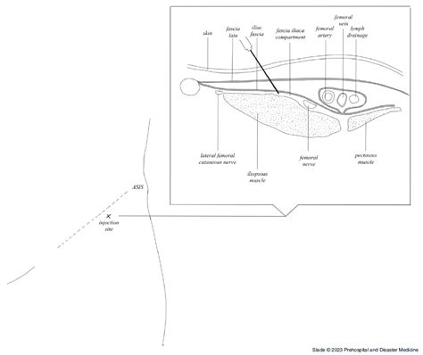 Efficacy of Fascia Iliaca Compartment Blocks in Proximal Femoral Fractures in the Prehospital ...