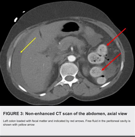 Ct Scan Abdomen Labeled | SexiezPix Web Porn