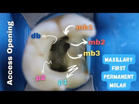 How To Find Mesiobuccal Canals Easily | Access Opening In Maxillary First Molar • Video ...