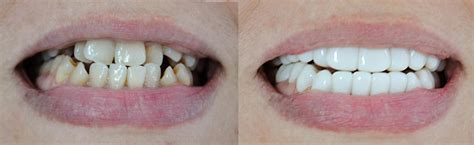 TruSmile Removable Veneers for a shiny white Perfect Smile