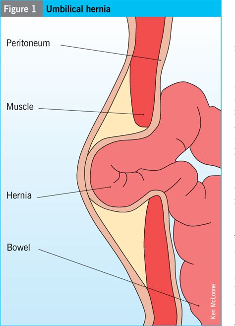 Figure 3 from Congenital and acquired umbilical hernias: examination ...