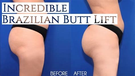 Incredible Brazilian Butt Lift (BBL) Before & After - YouTube