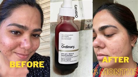 Aha Bha Exfoliating The Ordinary Review Outlet Discounts | www ...