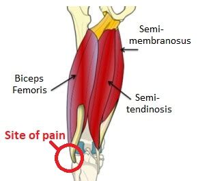 Lateral Knee Pain: Causes & Treatment - Knee Pain Explained (2022)