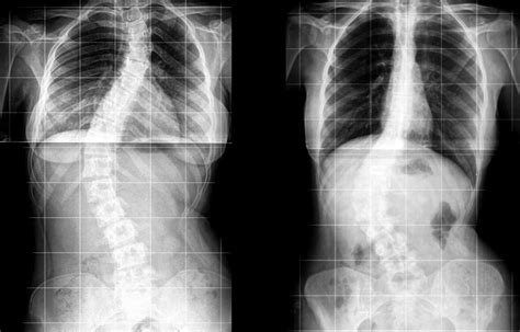 Diagnosis of Dextroconvex Curvature of the Spine | Easy Health Care ...