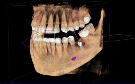 3D CBCT Technology