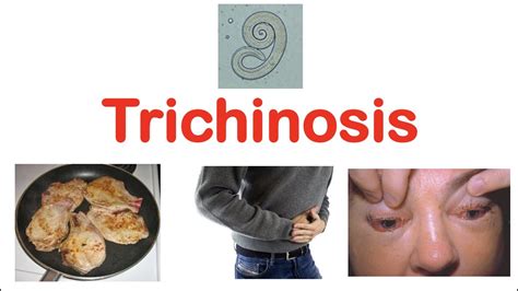 Trichinosis (Pork Parasite) | Pathophysiology, Signs & Symptoms, Diagnosis, Treatment - YouTube