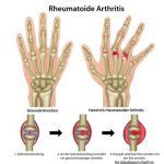 Understanding the Different Types of Rheumatoid Arthritis - Becker Spine