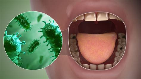 Bad Breath: Symptoms, Causes, and Treatment - Scientific Animations