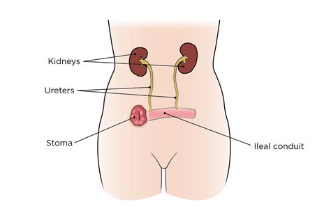 Bladder Cancer Surgery | Memorial Sloan Kettering Cancer Center