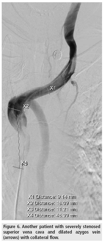 Stenting in malignant superior vena cava syndrome review advances