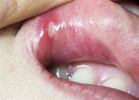 Mouth ulcers: Types, causes, symptoms, and treatment