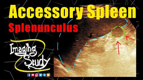 Accessory Spleen || Splenunculus || Ultrasound || Case 184 - YouTube