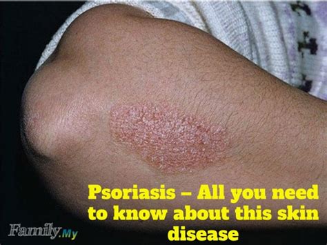 Psoriasis – All you need to know about this skin disease - Malaysia ...