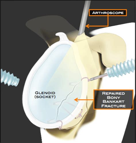 Bony Bankart Repair Austin, TX | Shoulder Fracture Round Rock | Cedar Park