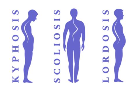 Stickler Syndrome : Overview, causes, symptoms, & treatment | FactDr