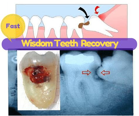 Wisdom Teeth Recovery Tip, Foods, 1st, 2nd 3rd Day & Precautions