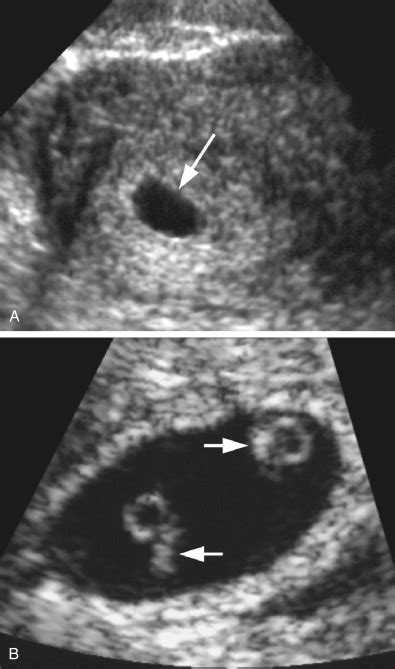 Ultrasound of the Early First Trimester | Obgyn Key