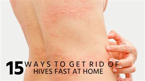 15 Ways to Get Rid of Hives Fast at Home | Allergy hives, Hives ...