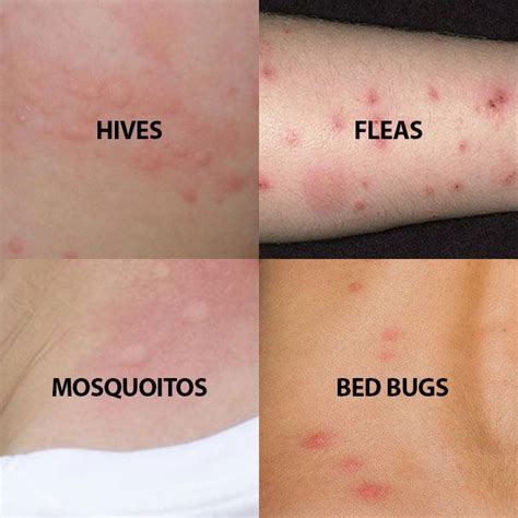 Do you think you have bed bugs? Read about the symptoms and signs, look at the photos and find ...