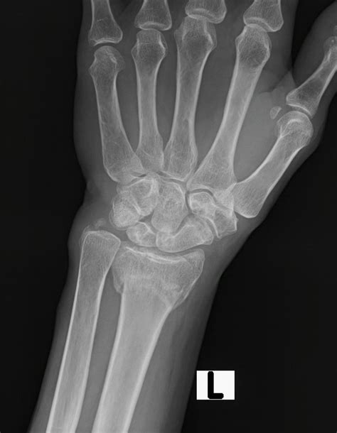 Colles fracture | Image | Radiopaedia.org