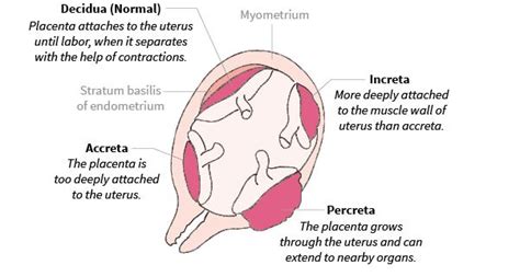 Placenta Percreta - Definition, Symptoms, Signs, Treatment, Diagnosis