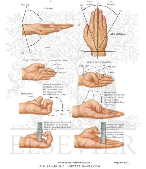 Measurement of Wrist Motion and Finger Motion, Lack of Finger Flexion ...