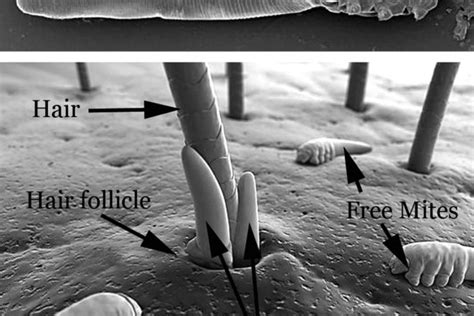 Demodex Mites Microscope