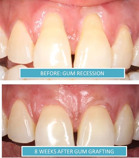 Alternative Treatment: Alternative Treatment Gum Recession