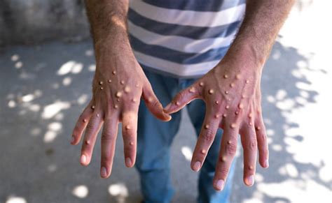 Monkeypox: 5th case reported in Kerala, 7 cases in India so far ...