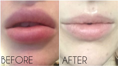 how to dissolve lip filler naturally at home - cleverncolorful