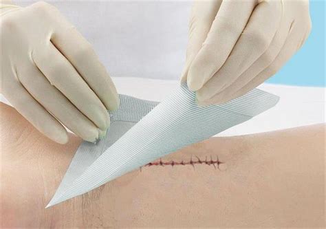 Incision Care and the Prevention of Surgical Site Infections - Medline