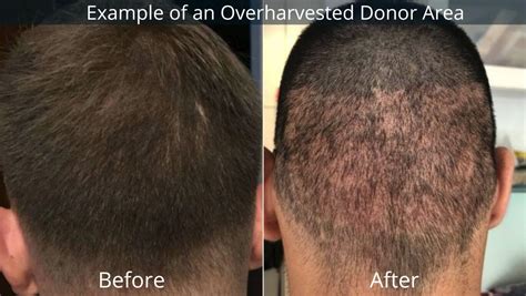 Aggregate more than 110 donor area after hair transplant - camera.edu.vn