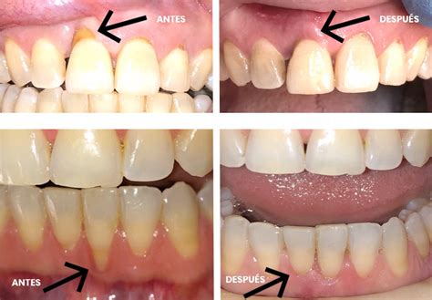 Cirugía de encías ¿Salud o Estética? - Dentista en Alicante | Implantes Dentales Clínica Dental ...