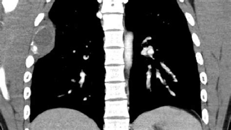 CT of chest with contrast. | Download Scientific Diagram