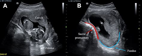 Incarcerated Gravid Uterus in a Nulliparous Female Presenting With ...