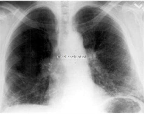 HYPERSENSITIVITY PNEUMONITIS Clinical features Diagnosis and Treatment of Hypersensitivity ...