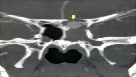 CT scan of the head fracture of the sphenoid sinus and protrusion of... | Download Scientific ...