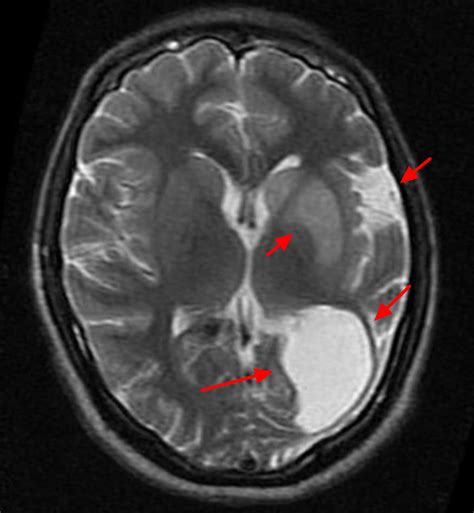 Rasmussen Encephalitis - Causes, Symptoms, Diagnosis, Treatment